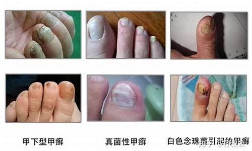 甲藓和灰指甲是一种病吗-癣和灰指甲的区别